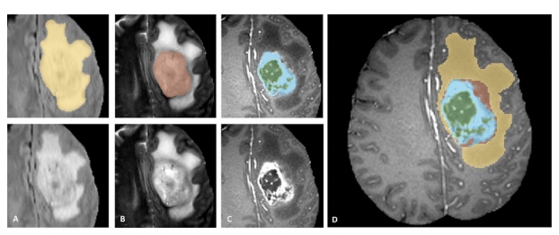 Brain Tumor