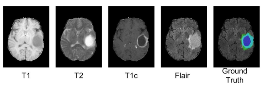 Brain Tumor